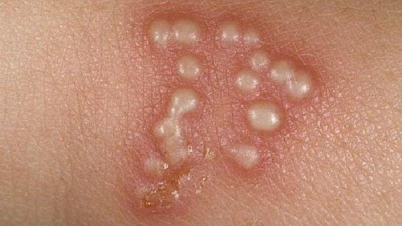 Rau diếp cá có khả năng ức chế sự phát triển của virus herpes